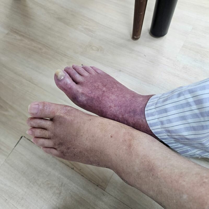 肢體腫脹造成的疼痛也會使患者的行動意願降低，肢體腫脹不同的原因需要不同的方法介入。(圖片來源/施柔安)